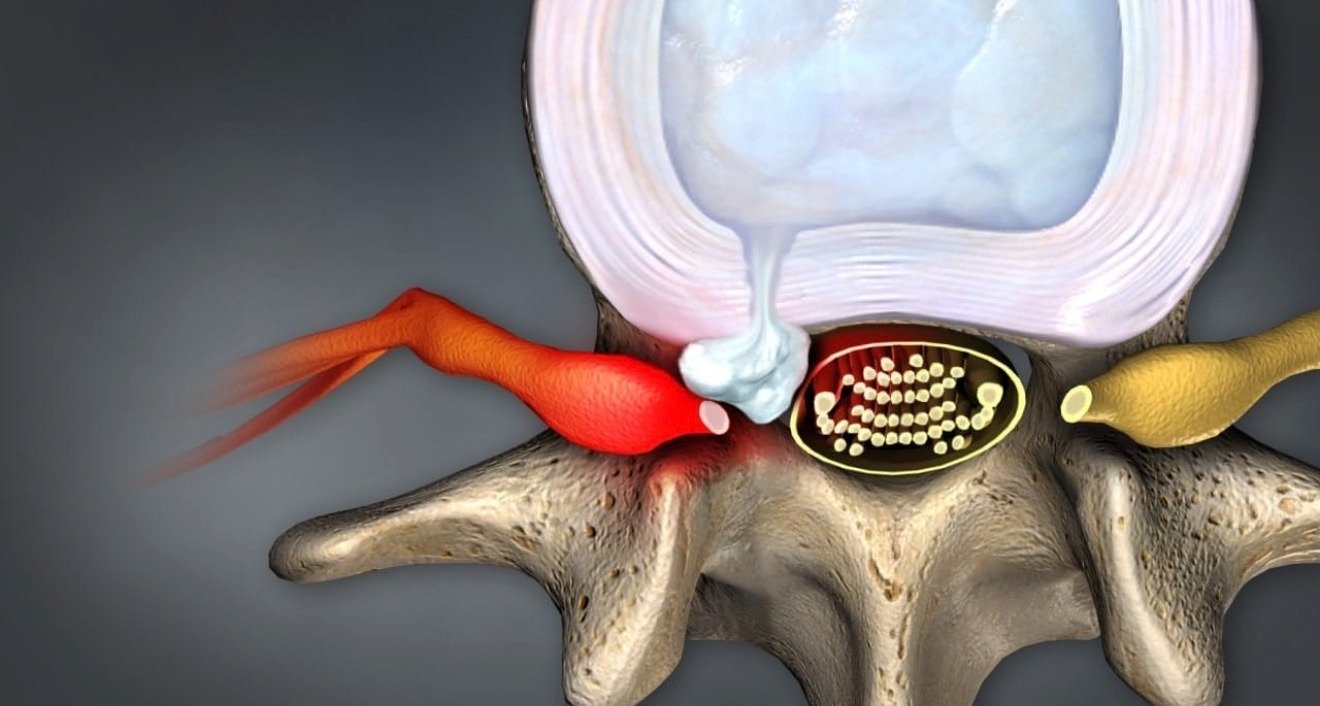 Hérnia de Disco: o que é, por que dói e como tratar